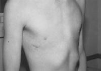 A 12-year-old boy 2 weeks after minimally invasiv...