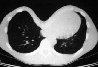 Preoperative CT scan of the chest of 12-year-old ...