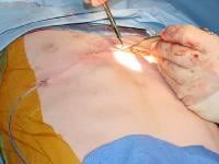 Closure of the anterior chest wall incision used ...