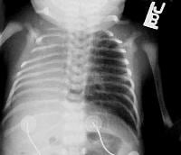 bell shaped thorax