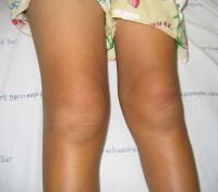 Effusion Of Knee