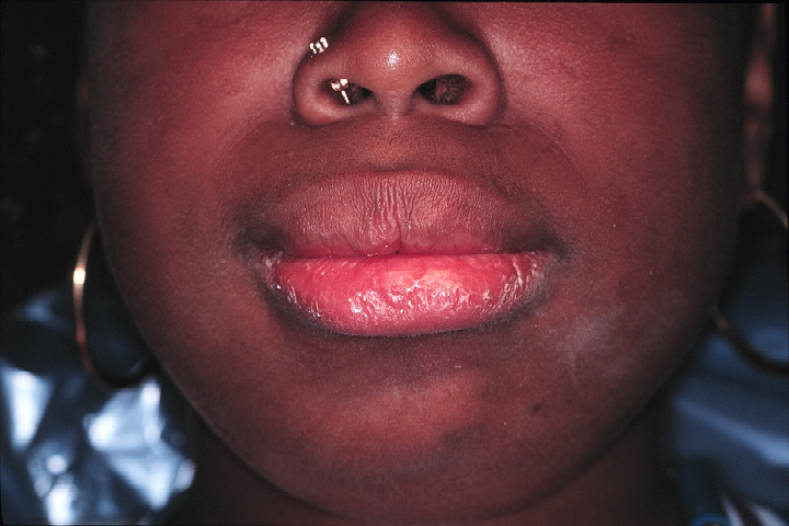 Lower facial appearance of a  14-year-old adolesce...