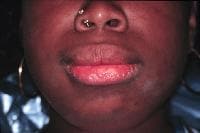 Lower facial appearance of a 14-year-old adolesce...