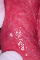 Erythema of the labial mucosa with enlargement of...