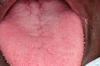 The dorsal surface of the tongue demonstrates gen...