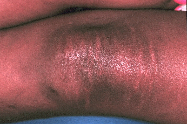 A 14-year-old adolescent girl  with Sjögren s...