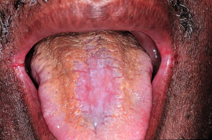 The dorsal tongue demonstrates  hyperplastic candi...