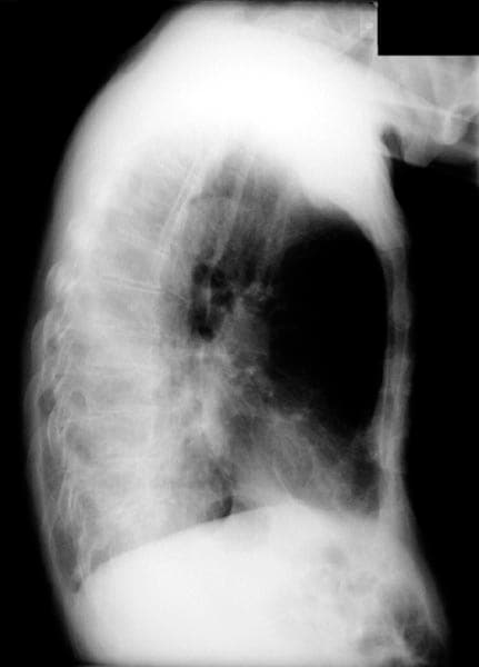 Atelectasis. Left lower lobe collapse. The opacit...