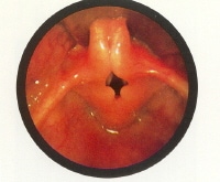 Laryngomalacia: The epiglottis is small and curled