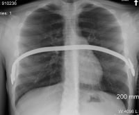 Chest radiograph of a 16-year-old patient in whic...