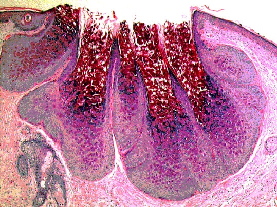 Pathology Outlines - Molluscum contagiosum