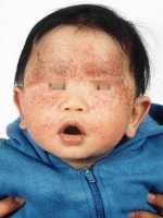 baby atopic dermatitis
