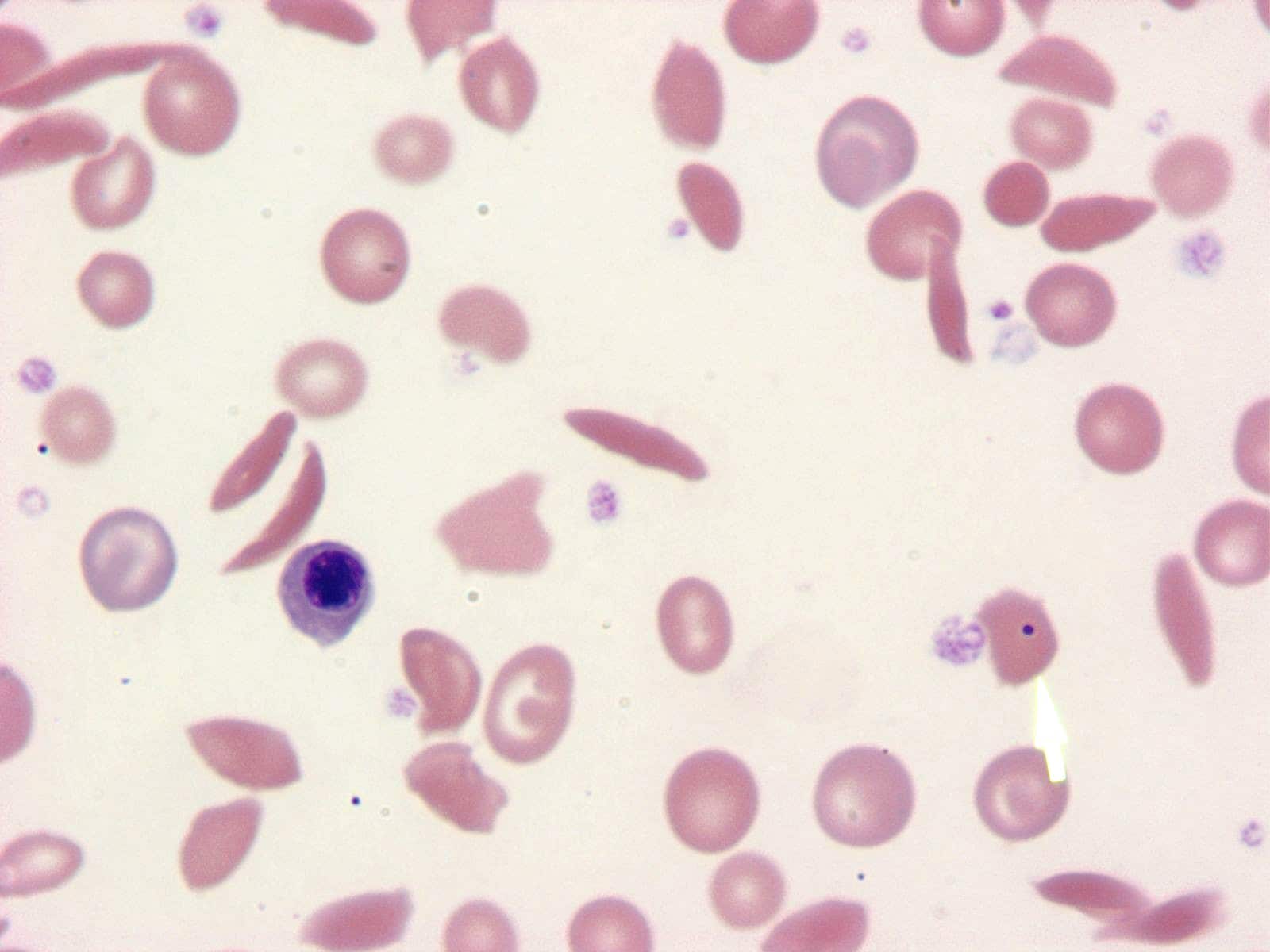 Sickle Cell Anemia Smear