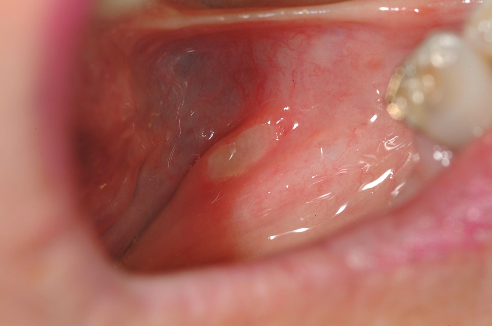 Recurrent aphthae in floor of  mouth, showing ovoi...