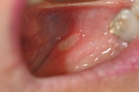 Recurrent aphthae in floor of mouth, showing ovoi...