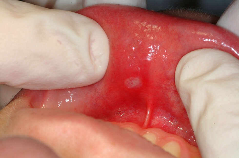 Typical aphthous ulcer in a  common site, showing ...