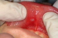 oral aphthae