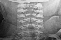 Tracheitis