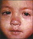 Measles conjunctivitis 