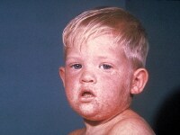Face of boy with measles 