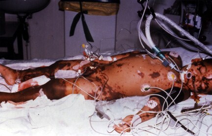 Child with severe meningococcal disease and purpura fulminans. Child with severe meningococcal disease and purpura fulminans.