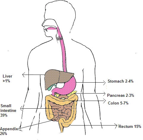 Carcinoid Tumor Appendix. Carcinoid Tumor: Multimedia - eMedicine Pediatrics: General Medicine emedicine.medscape.com