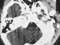 rhabdomyosarcoma images