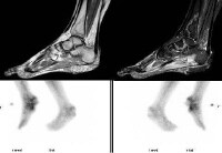 Bone Edema Mri