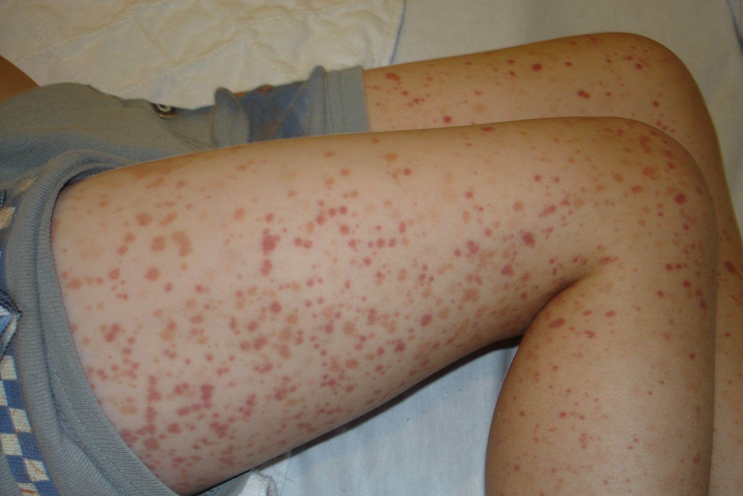 What does it mean if you have a purpura rash?