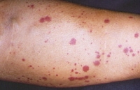 Purpura Disease