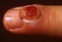 granuloma finger