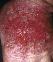 Acute Eczematous Dermatitis
