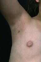 Axillary freckling showing café au lait spots. 