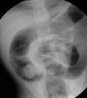 Target Sign Intussusception