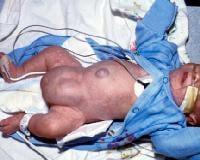 Inguinal Hernia Children