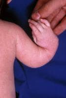 Infant Petechiae