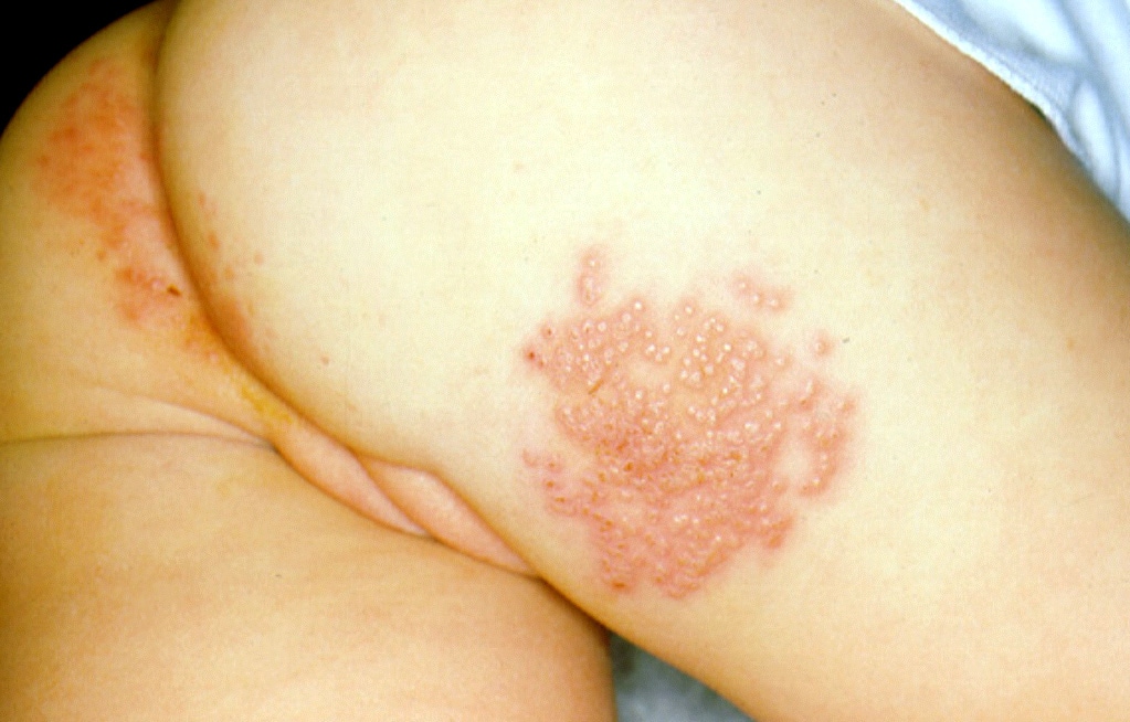 Cutaneous herpes simplex virus (HSV) lesions in a child in whom sexual abuse 