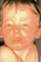 Child with measles. Photograph courtesy of Centers