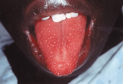 Strawberry tongue.