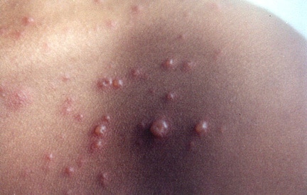 dewisuryoningsih: varicella