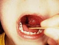 Tonsil Abscess Treatment