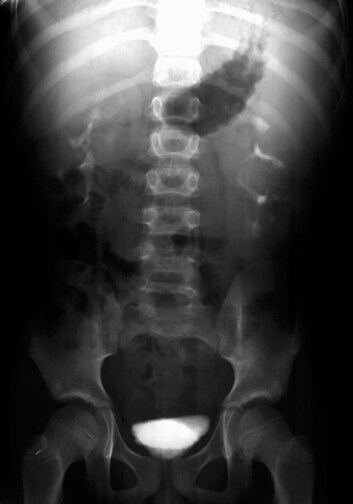 pathology of the excretory system