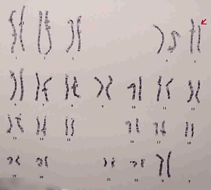 G-banded karyotype [46,XX,del(5)(p13)].