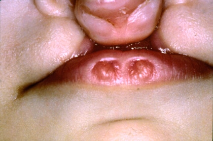 Closer view of cleft lip and cleft palate in an i.
