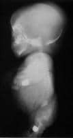 Lateral view radiograph of an infant with achondro