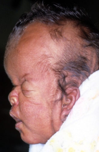 In this profile, turribrachycephaly, high promine...
