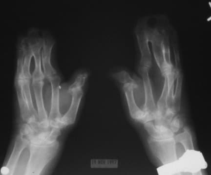 Note osseous syndactyly involving the second, thi...