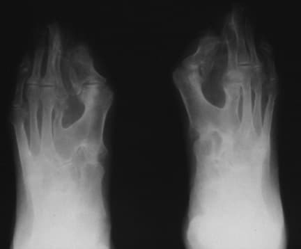 Note osseous syndactyly, fusion of interphalangea...
