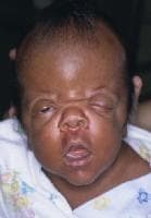 An infant with Apert syndrome is shown. Note the ...