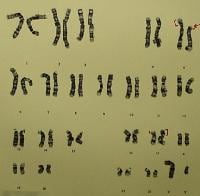G-banded karyotype of a carrier father [46,XY,t(5...